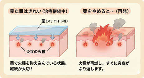 【治らない時は】アトピー性皮膚炎かもしれません